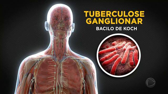 Tuberculose ganglionar imagem