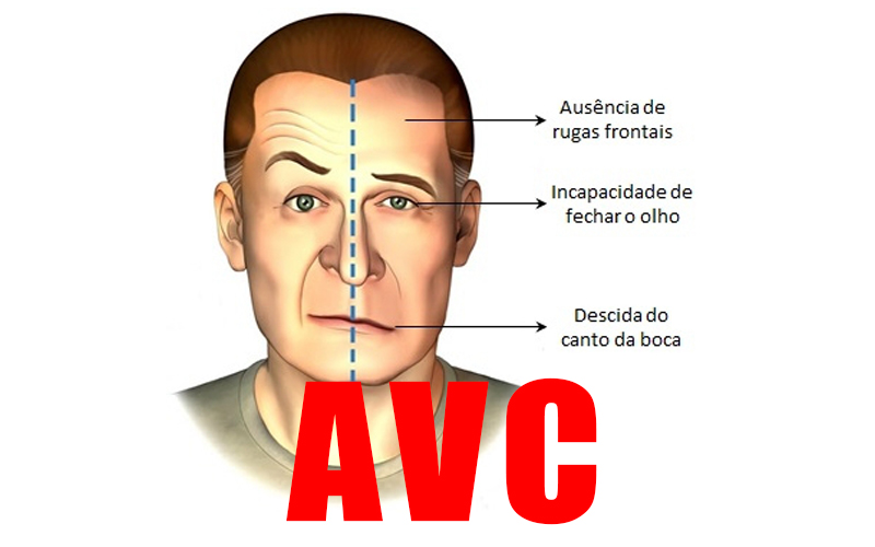 MEDICAMENTO AVC 2