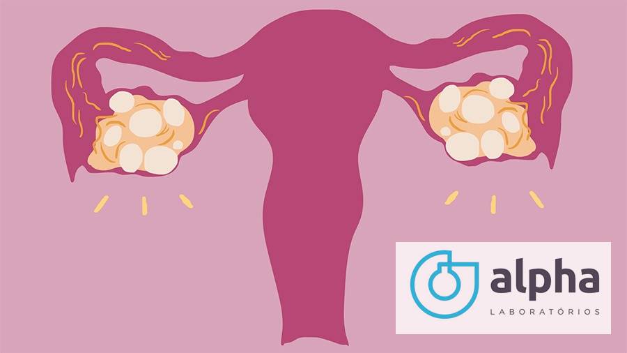 10 SEMANA 03 02 Quais os sintomas e como reconhecer a sndrome do ovrio policstico