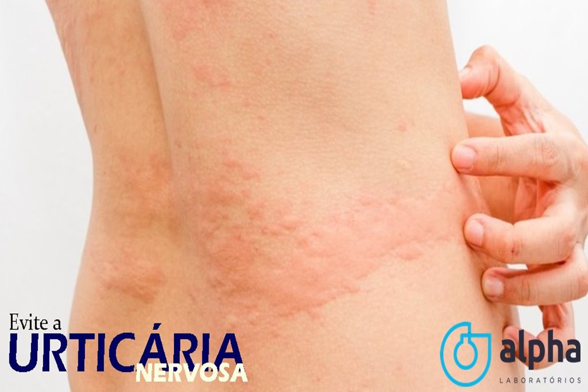 2019 08 19 URTICARIA SITE2
